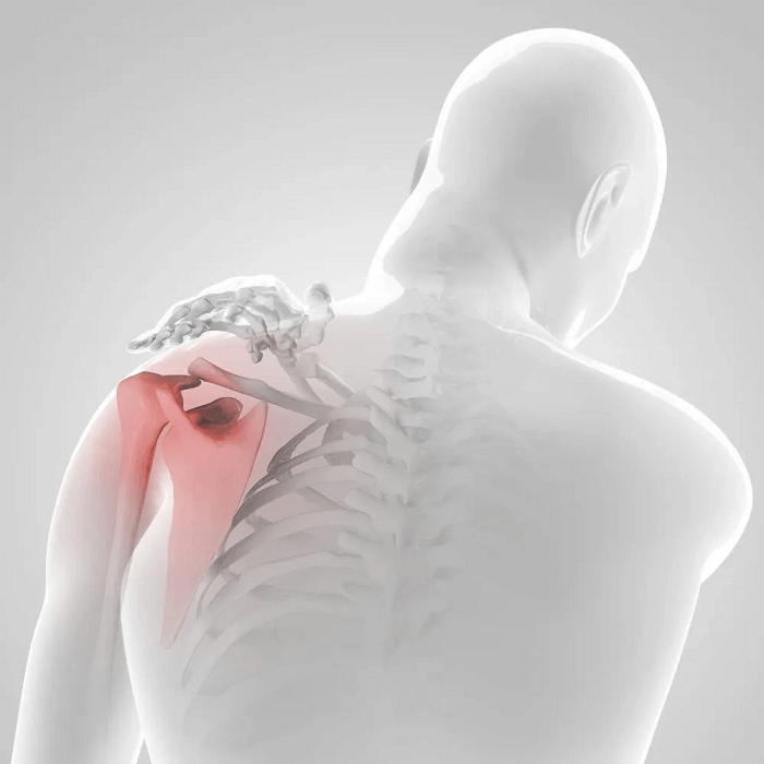 Shoulder pain in hemiplegia cannot be ignored