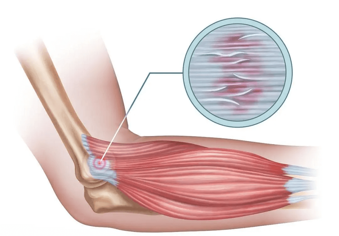tennis_elbow.png tennis_elbow.png